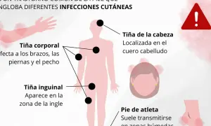 Ilustración muestra tiña corporal, inguinal y de cabeza, con sus síntomas y zonas afectadas. Alerta de salud.