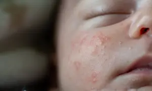 Bebé con piel atopica, mejillas enrojecidas y con pequeñas protuberancias.