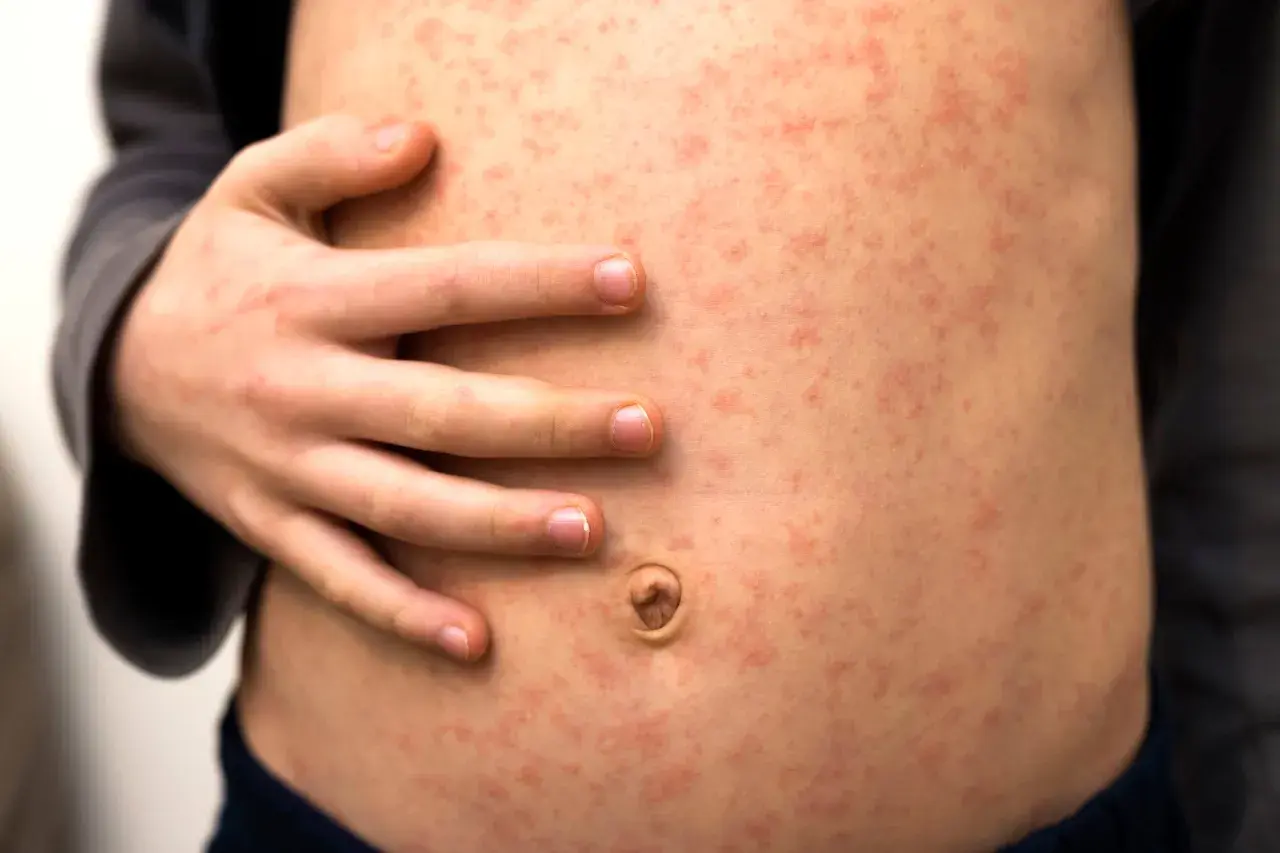 Un abdomen infantil cubierto de pequeños puntos rojos, mostrando varios tipos de sarpullidos.