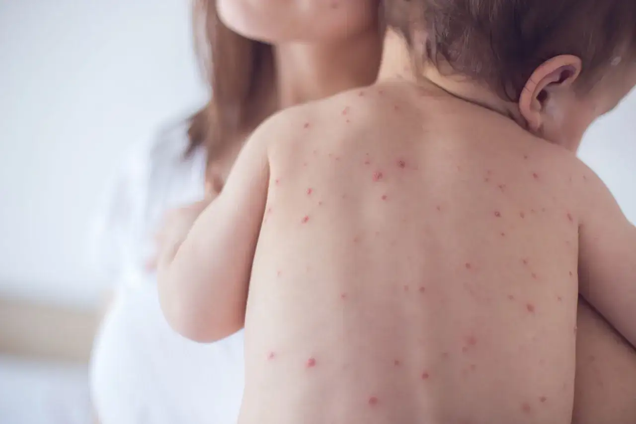 Bebé con varios tipos de sarpullidos rojos en la espalda, sostenido por una madre.