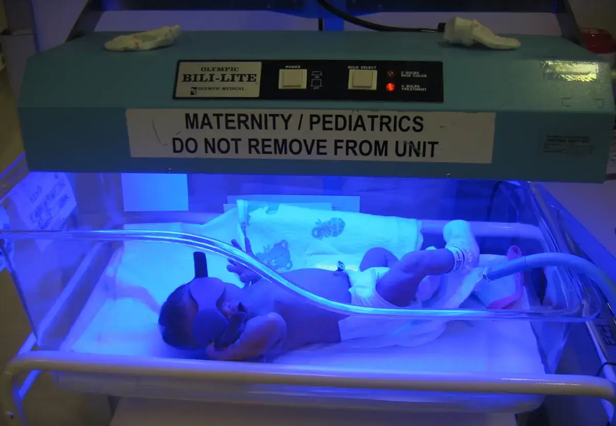 Beb&eacute; con bilirrubina alta en tratamiento con fototerapia azul.