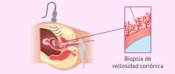 Ilustración de una biopsia corial guiada por ultrasonido, mostrando la toma de muestra de vellosidades coriónicas para análisis genético.