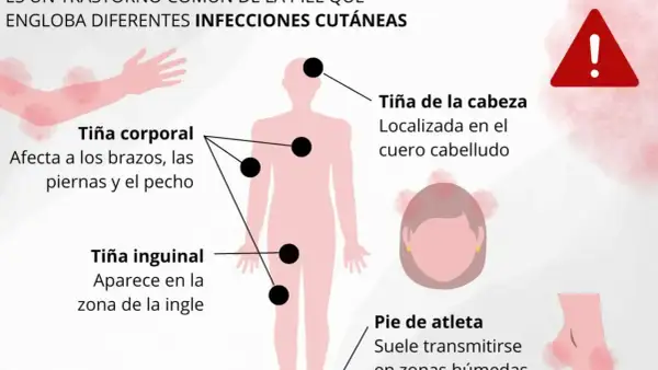 Ilustración muestra tiña corporal, inguinal y de cabeza, con sus síntomas y zonas afectadas. Alerta de salud.