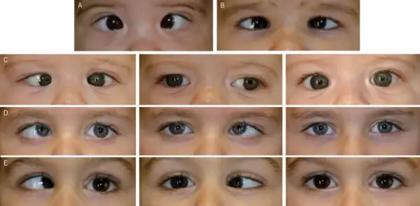 Primeros planos de ojos de bebés y niños pequeños, mostrando diferentes tipos de estrabismo en niños de 1 a 2 años.
